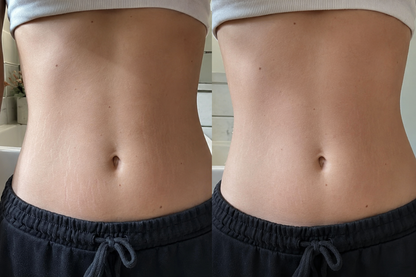 Crema Reductora de Estrías y Celulitis